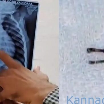 ಉಸಿರಾಟದ ತೊಂದರೆಗೆ 1 ವರ್ಷದ ಮಗುವನ್ನು ಆಸ್ಪತ್ರೆಗೆ ಒಯ್ದರೆ ಶ್ವಾಸಕೋಶದಲ್ಲಿ ಎಲ್‌ಇಡಿ ಬಲ್ಬ್‌ ಕಂಡು ವೈದ್ಯರೇ ಶಾಕ್‌ !